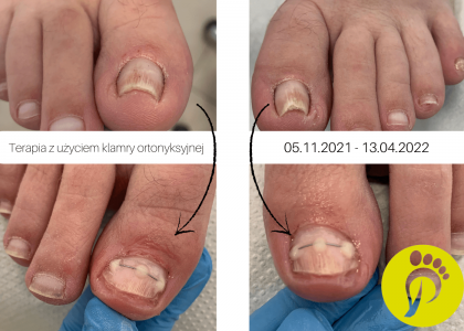 Terapia paznokci wkręcających się. Gabinet podologiczny. Justyna Tujko