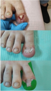 Terapia paznokcia wrastającego- najwyższy stopień wrastania. Paznokieć wrastający. Gabinet podologiczny. Justyna Tujko.