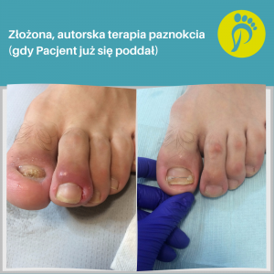 Tym razem stan po chirurgicznym zerwaniu płytki. Paznokieć dużego palca z zatrzymanym wzrostem. Wrastający paznokieć palca drugiego. Terapia zakończona sukcesem. Gabinet Podologiczny Justyna Tujko